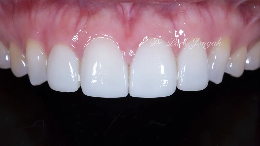 Trường hợp đã tiến hành làm lại Veneer — ảnh 1