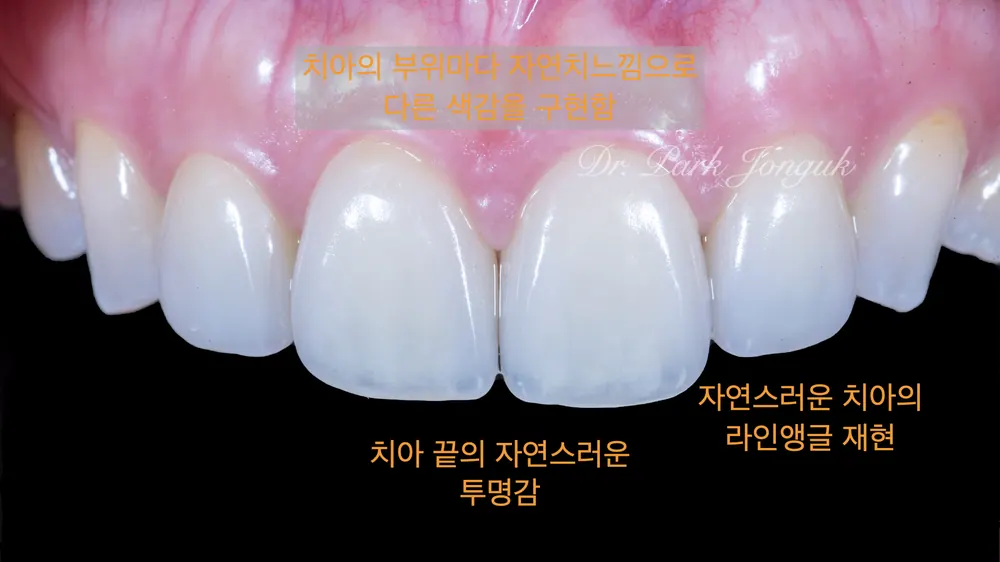 Trường hợp đã tiến hành làm lại Veneer — ảnh 5