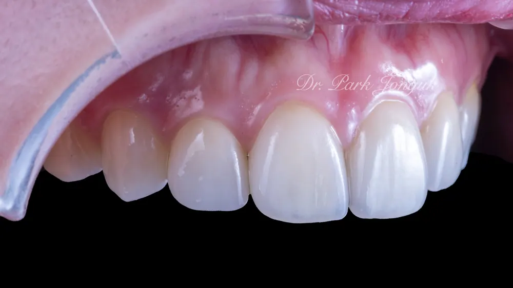 Trường hợp đã tiến hành làm lại Veneer — ảnh 6