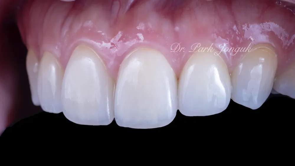 Trường hợp đã tiến hành làm lại Veneer — ảnh 7