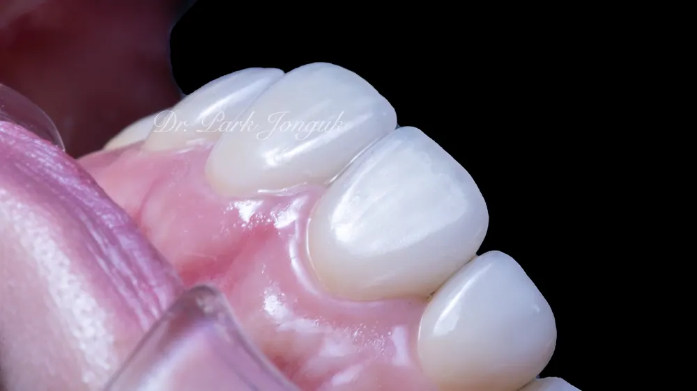 Trường hợp đã tiến hành làm lại Veneer — ảnh 8