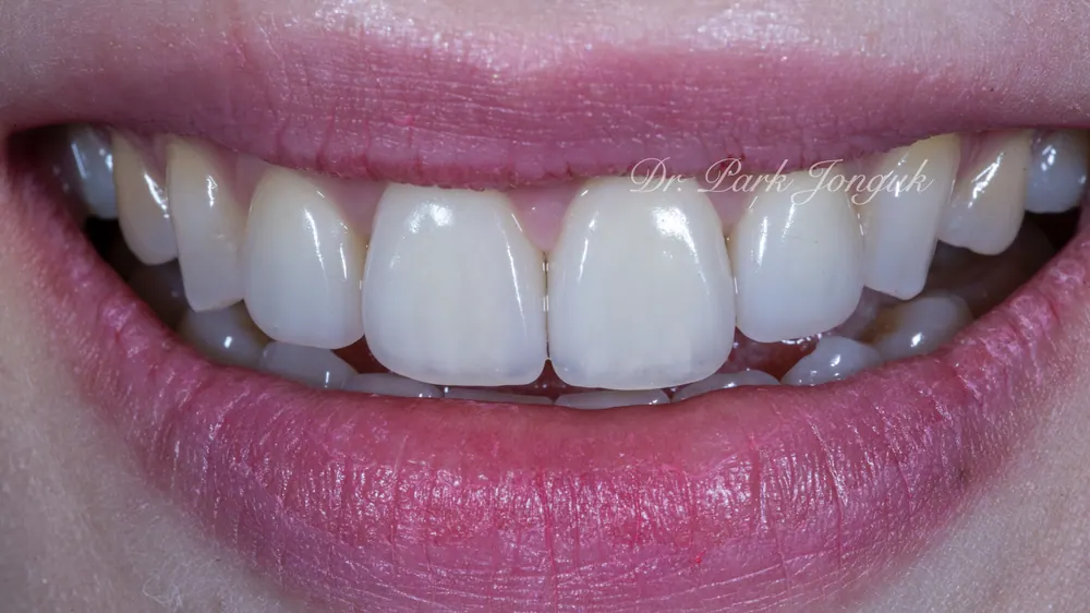 Trường hợp đã tiến hành làm lại Veneer — ảnh 9