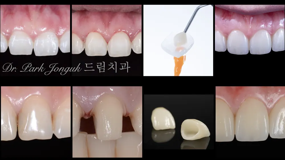 Peg Lateral Veneers, Gapped Teeth, and All-Ceramic Crown Retreatment — photo 1