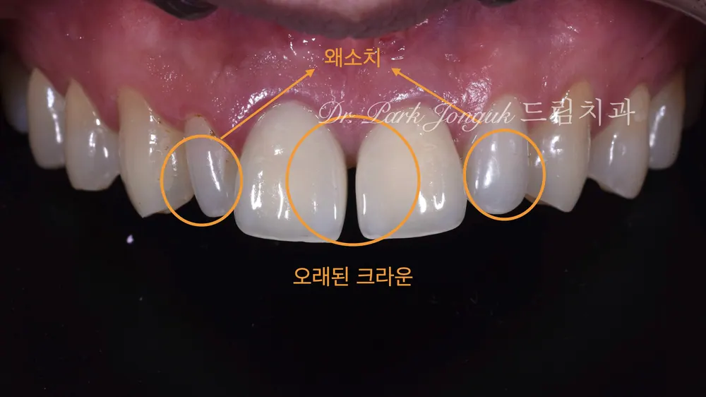 Peg Lateral Veneers, Gapped Teeth, and All-Ceramic Crown Retreatment — photo 3