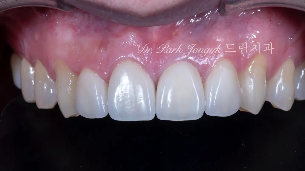 Peg Lateral Veneers, Gapped Teeth, and All-Ceramic Crown Retreatment — photo 5