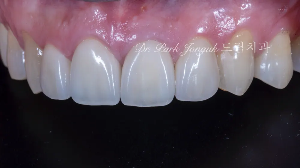 Peg Lateral Veneers, Gapped Teeth, and All-Ceramic Crown Retreatment — photo 7