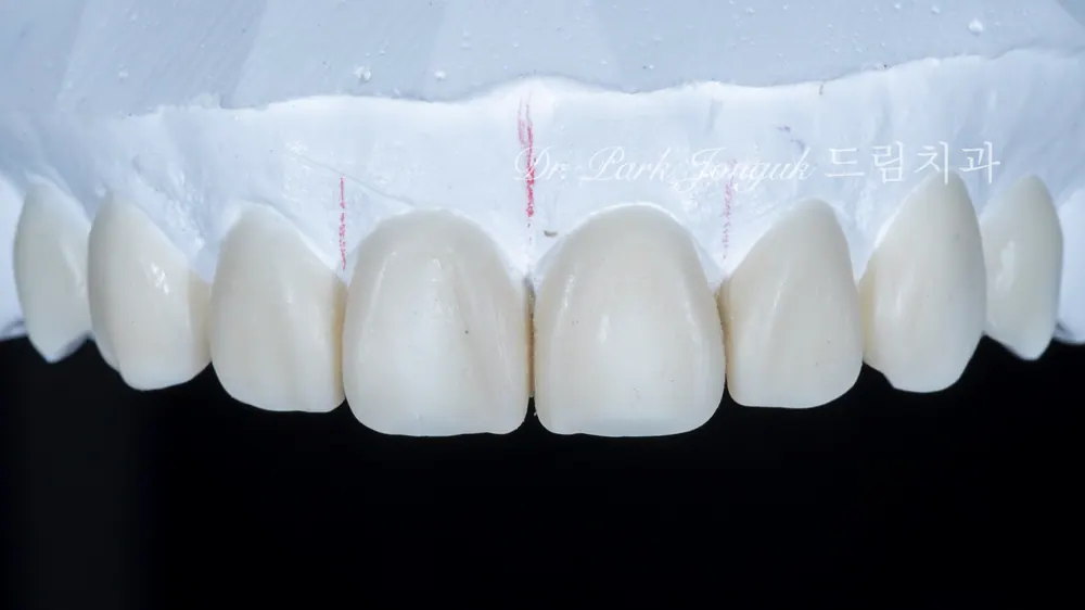 Dán sứ Veneer Apgujeong: điều trị Veneer cho răng thưa — ảnh 3