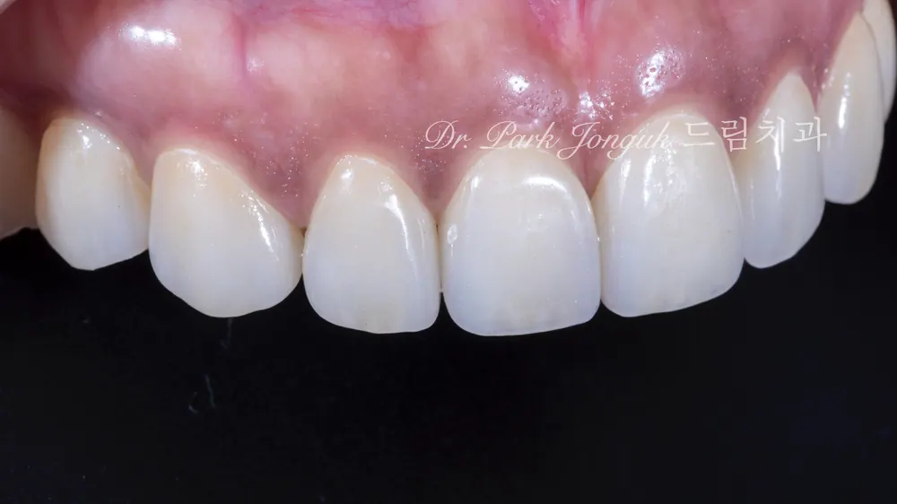 Dán sứ Veneer Apgujeong: điều trị Veneer cho răng thưa — ảnh 7