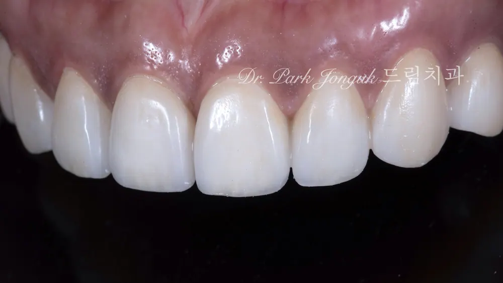 Dán sứ Veneer Apgujeong: điều trị Veneer cho răng thưa — ảnh 8
