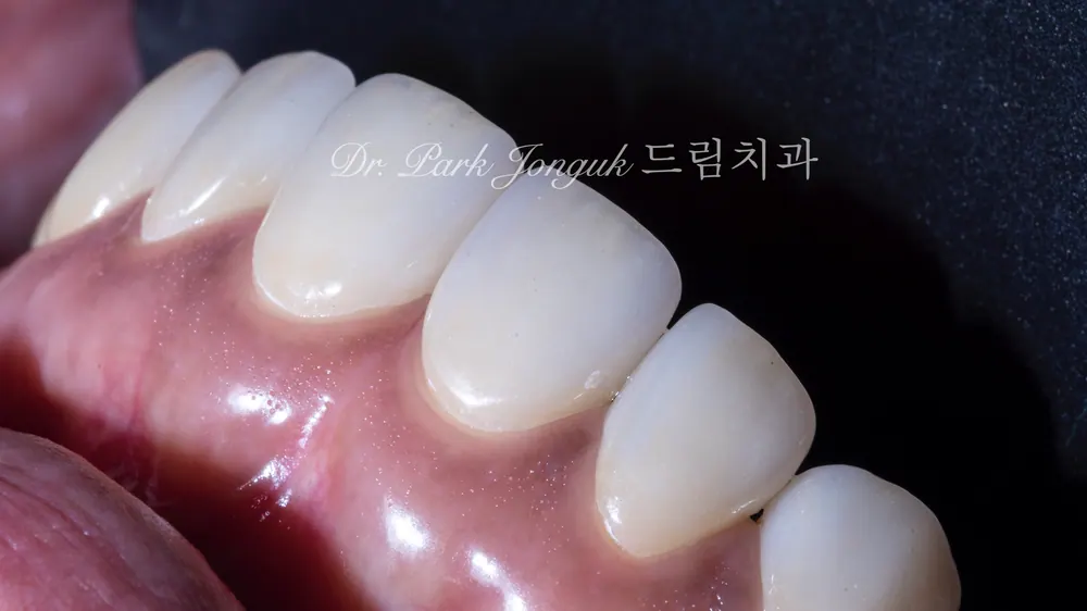 Dán sứ Veneer Apgujeong: điều trị Veneer cho răng thưa — ảnh 9