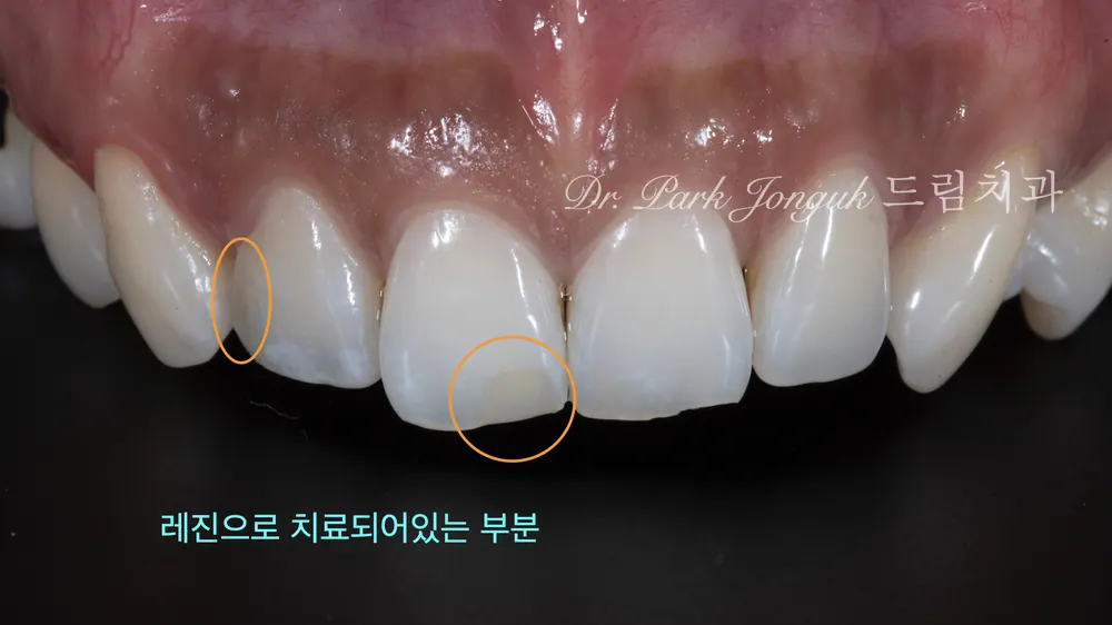 วีเนียร์สถานีชองดัม กรณีทำให้ฟันเรียบเสมอและเป็นธรรมชาติยิ่งขึ้น — ภาพที่ 2