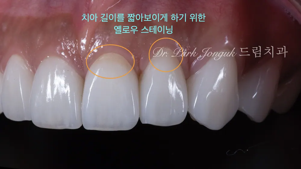 วีเนียร์สถานีชองดัม กรณีทำให้ฟันเรียบเสมอและเป็นธรรมชาติยิ่งขึ้น — ภาพที่ 6
