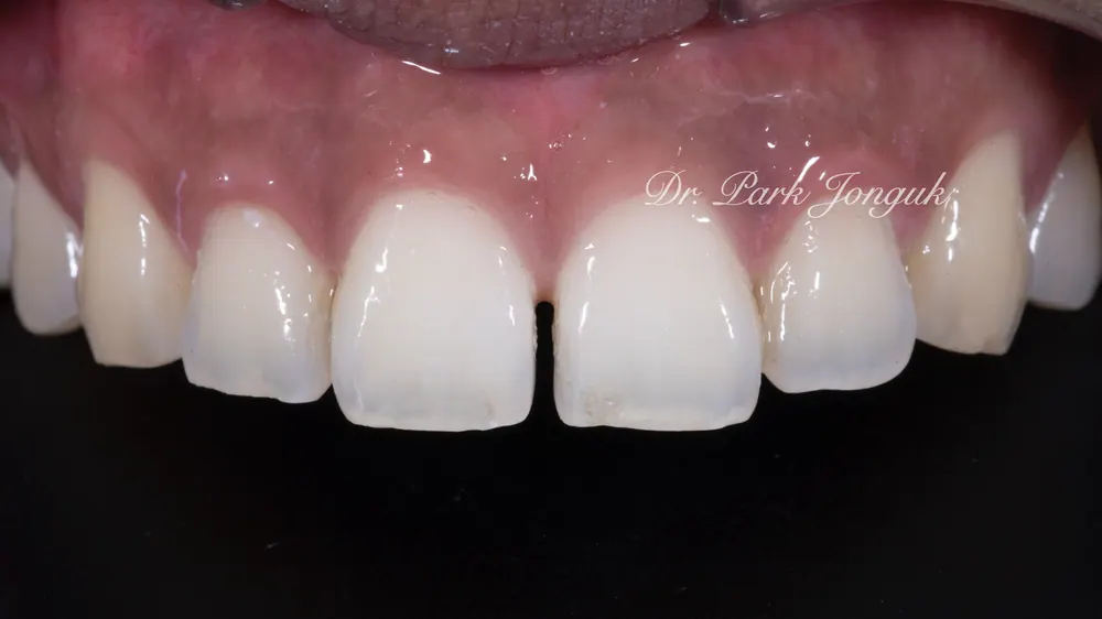 Ca điều trị dán sứ Veneer bán phần không mài răng cho răng thưa — ảnh 1