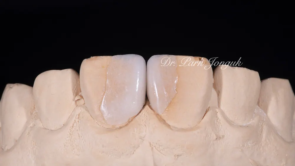 Ca điều trị dán sứ Veneer bán phần không mài răng cho răng thưa — ảnh 3
