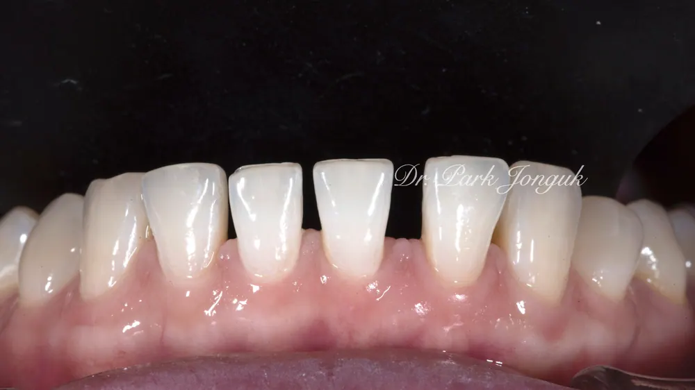 Ca điều trị dán sứ Veneer bán phần không mài răng cho răng thưa — ảnh 6