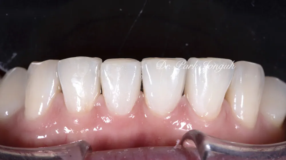 Ca điều trị dán sứ Veneer bán phần không mài răng cho răng thưa — ảnh 8