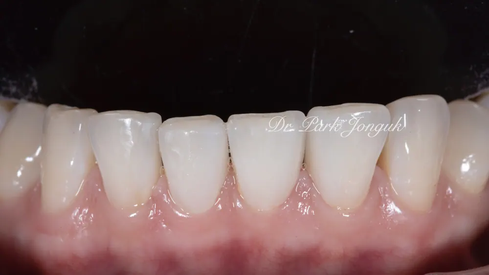 Ca điều trị dán sứ Veneer bán phần không mài răng cho răng thưa — ảnh 9