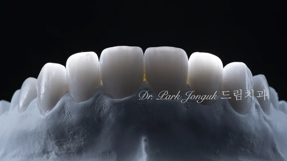 不磨牙、最小磨牙瓷贴面，打造自然美丽的牙齿 — 图7