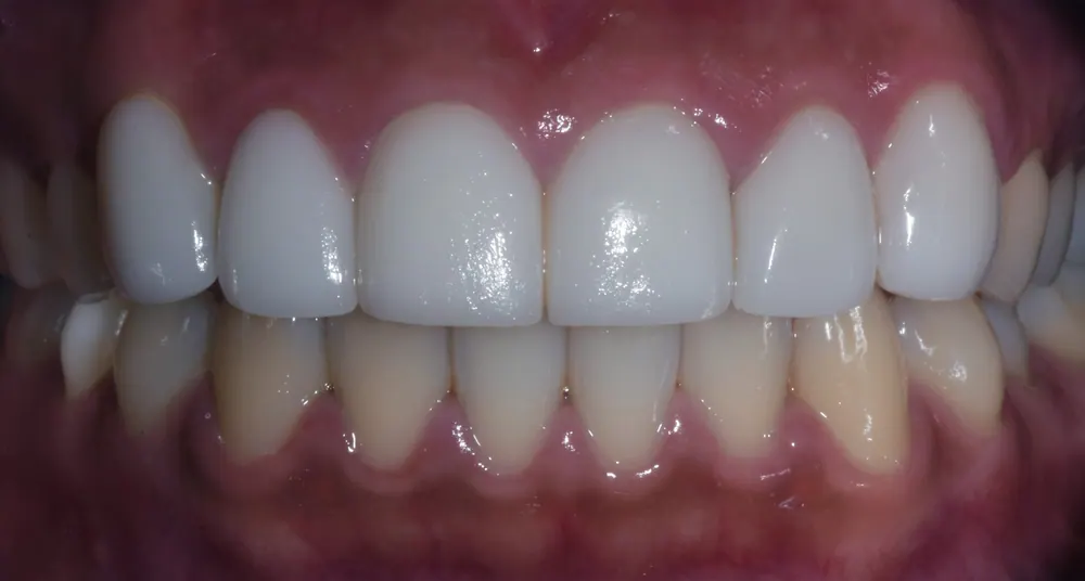 All-Ceramic Crown Retreatment and Front-Tooth Veneers — photo 1