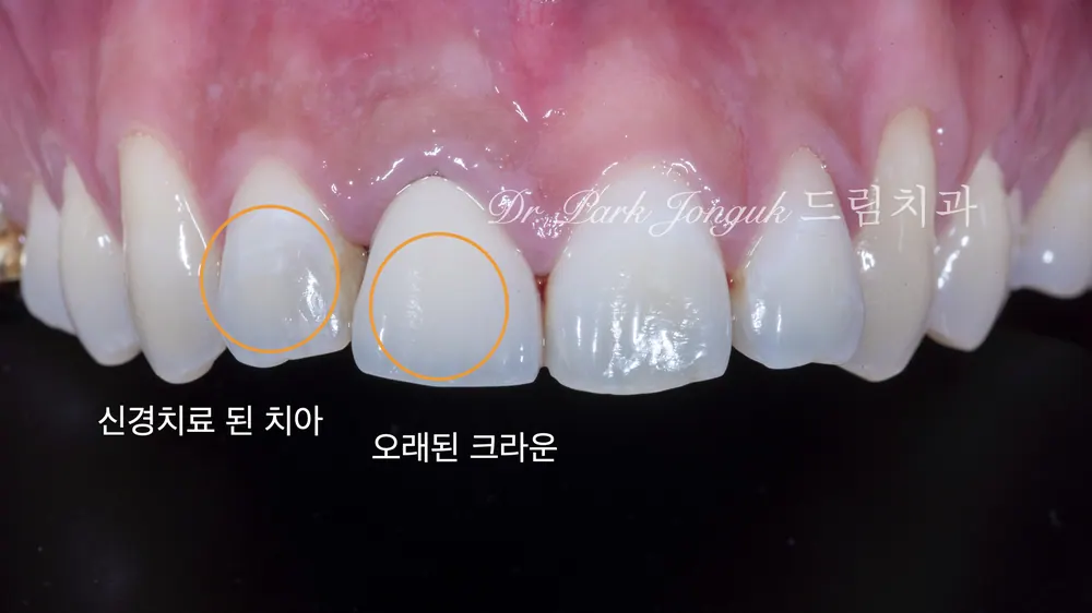 All-Ceramic Crown Retreatment and Front-Tooth Veneers — photo 3