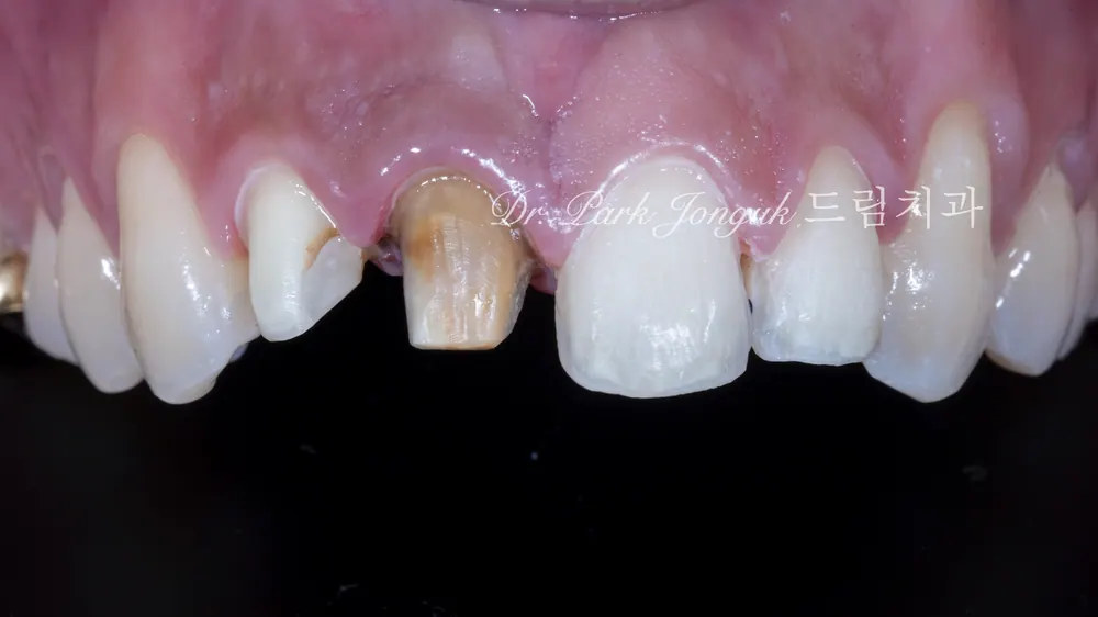All-Ceramic Crown Retreatment and Front-Tooth Veneers — photo 4