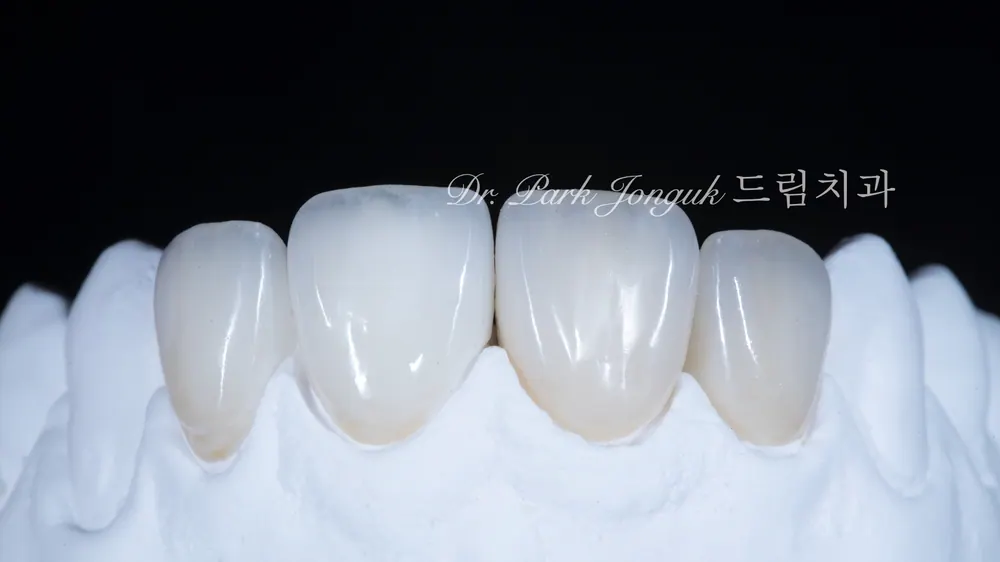 All-Ceramic Crown Retreatment and Front-Tooth Veneers — photo 5