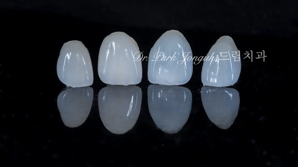 All-Ceramic Crown Retreatment and Front-Tooth Veneers — photo 6