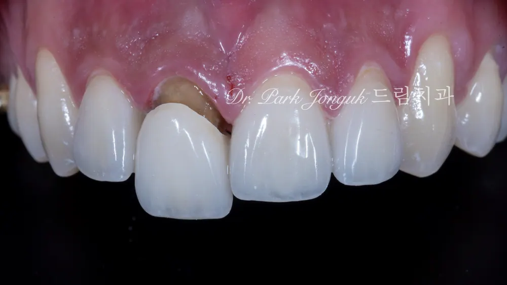 All-Ceramic Crown Retreatment and Front-Tooth Veneers — photo 7