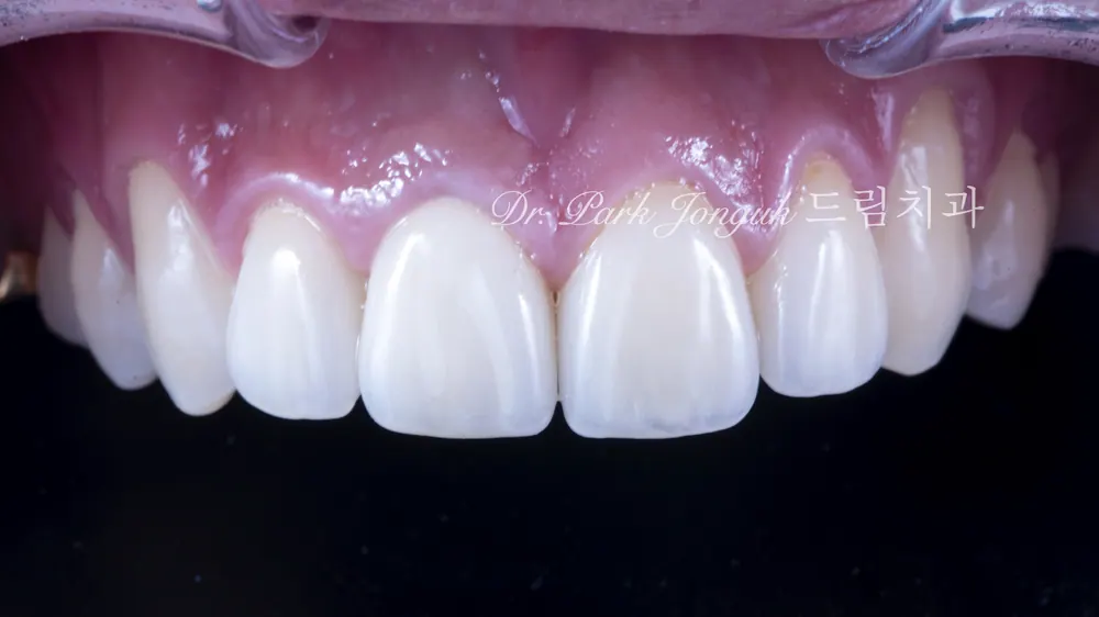All-Ceramic Crown Retreatment and Front-Tooth Veneers — photo 8