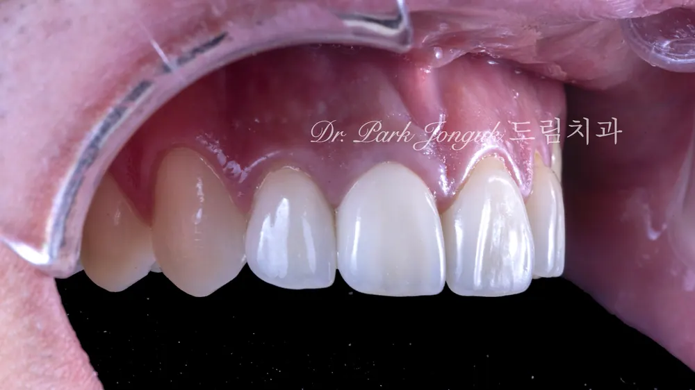 All-Ceramic Crown Retreatment and Front-Tooth Veneers — photo 9