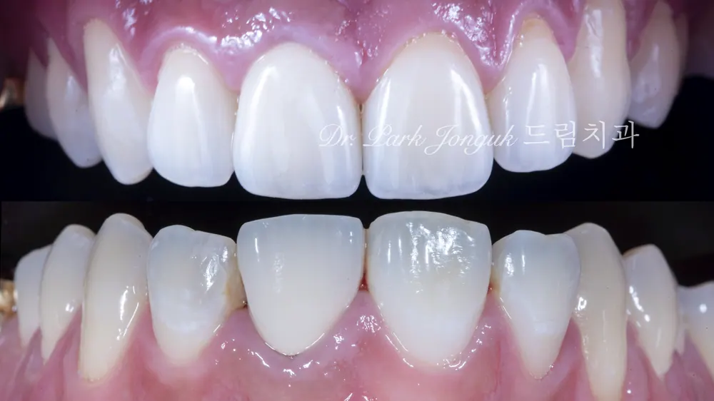 All-Ceramic Crown Retreatment and Front-Tooth Veneers — photo 11
