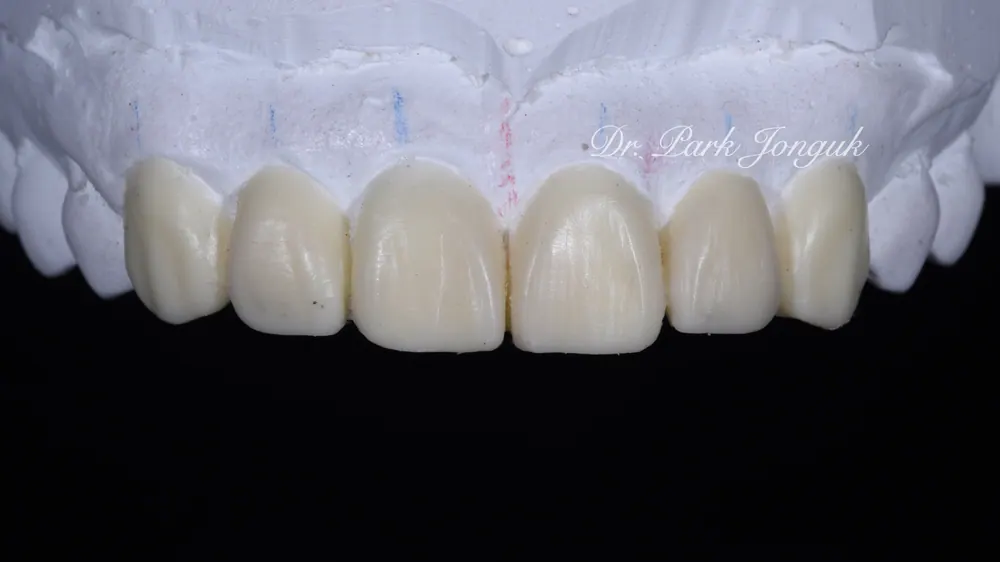 Điều trị dán sứ Veneer răng cửa chỉnh hàm răng lệch lạc và răng cửa bên nhỏ — ảnh 4