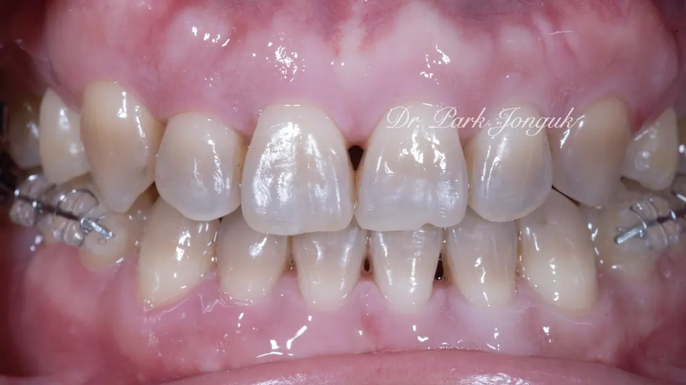 Nha khoa giỏi làm Veneer: điều trị Veneer răng cửa nhiễm màu do kháng sinh Tetracycline và các loại thuốc khác — ảnh 1