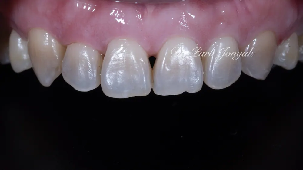 Nha khoa giỏi làm Veneer: điều trị Veneer răng cửa nhiễm màu do kháng sinh Tetracycline và các loại thuốc khác — ảnh 2