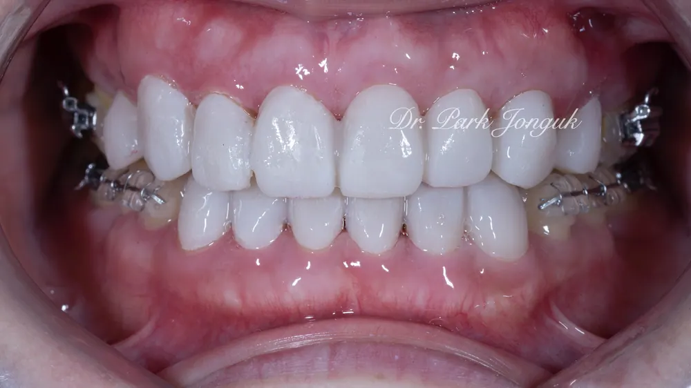 Nha khoa giỏi làm Veneer: điều trị Veneer răng cửa nhiễm màu do kháng sinh Tetracycline và các loại thuốc khác — ảnh 4