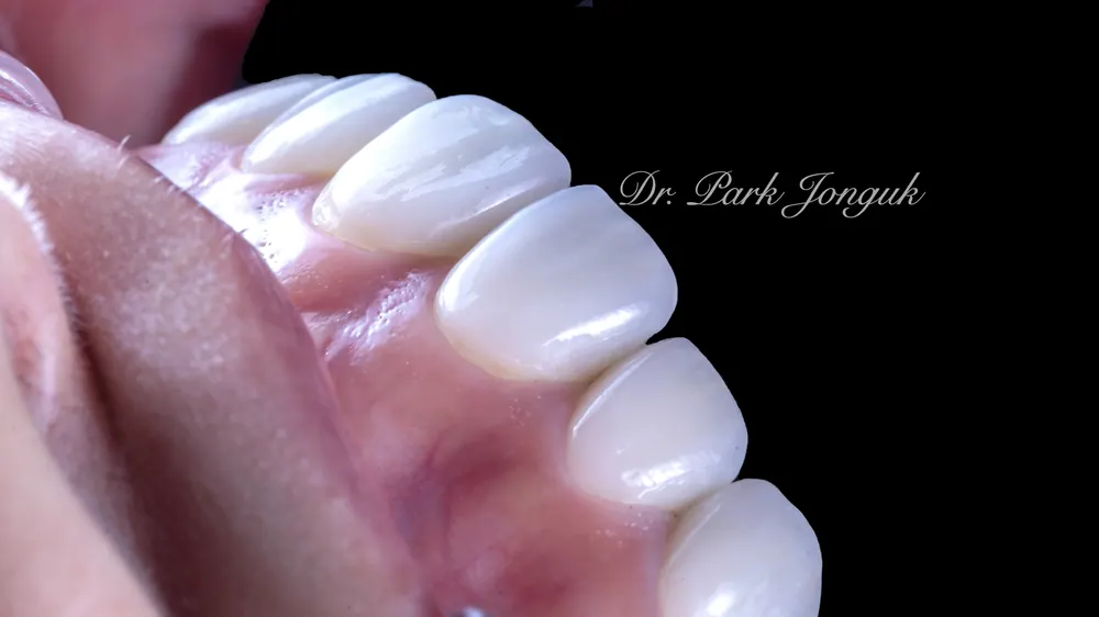 Nha khoa giỏi làm Veneer: điều trị Veneer răng cửa nhiễm màu do kháng sinh Tetracycline và các loại thuốc khác — ảnh 7