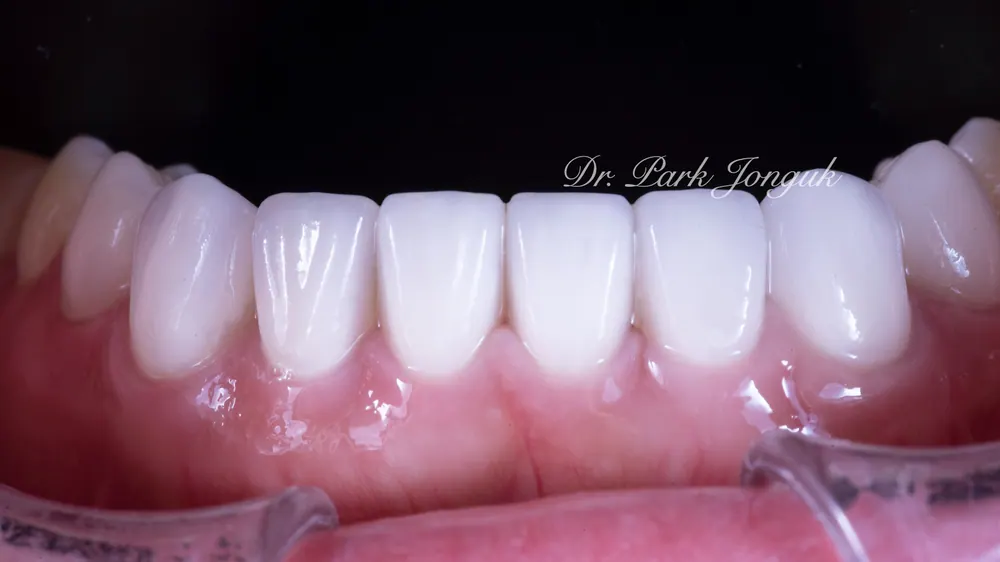 Nha khoa giỏi làm Veneer: điều trị Veneer răng cửa nhiễm màu do kháng sinh Tetracycline và các loại thuốc khác — ảnh 8