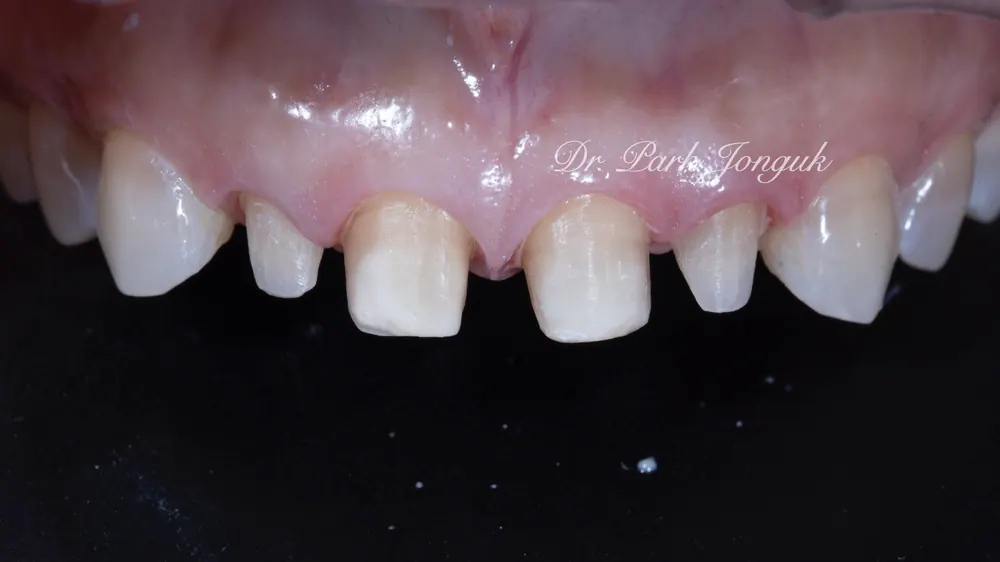 Veneer tại Apgujeong-dong: làm lại tự nhiên cho Veneer răng cửa thiếu tự nhiên — ảnh 2