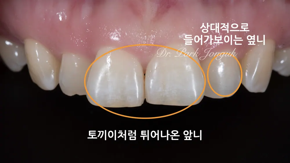 คลินิกทันตกรรมดรีม ซินซา แก้ฟันกระต่ายให้สวยงามด้วยวีเนียร์ฟันหน้า — ภาพที่ 2