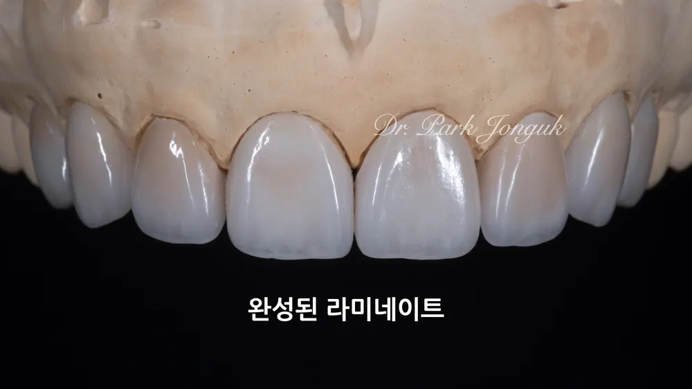 คลินิกทันตกรรมดรีม ซินซา แก้ฟันกระต่ายให้สวยงามด้วยวีเนียร์ฟันหน้า — ภาพที่ 3