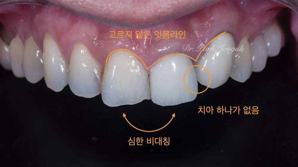 清潭洞瓷贴面·全瓷冠，前牙瓷贴面的再治疗 — 图2