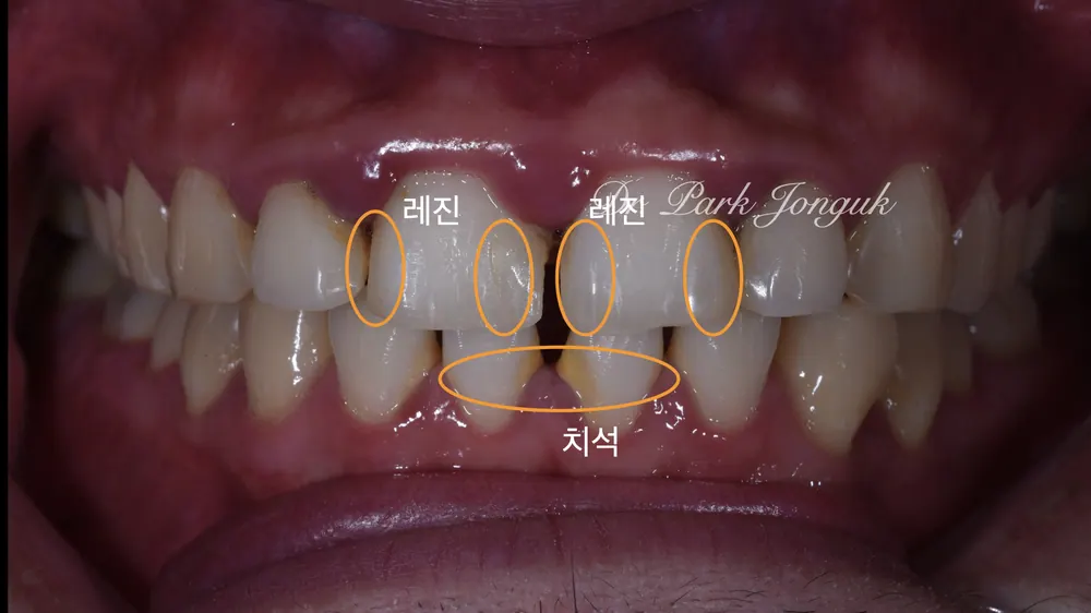 Sinsa Veneers: Beautifully Treating Gapped Teeth and Gum Inflammation With Front Teeth Veneers — photo 2