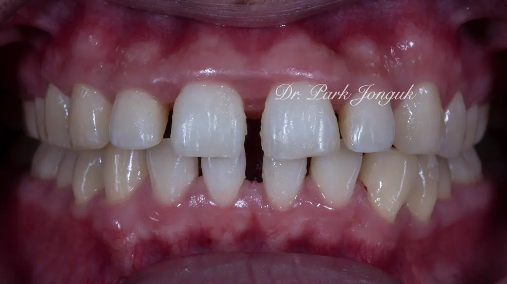 Sinsa Veneers: Beautifully Treating Gapped Teeth and Gum Inflammation With Front Teeth Veneers — photo 3