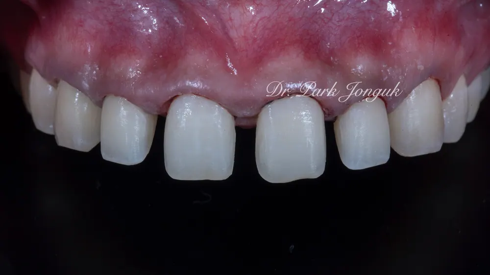Sinsa Veneers: Beautifully Treating Gapped Teeth and Gum Inflammation With Front Teeth Veneers — photo 4