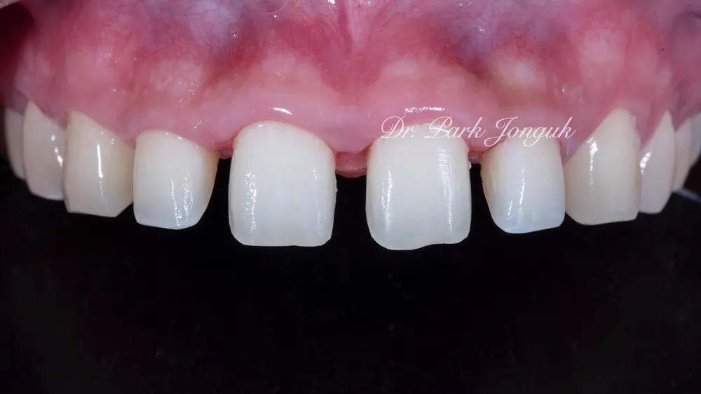 Sinsa Veneers: Beautifully Treating Gapped Teeth and Gum Inflammation With Front Teeth Veneers — photo 8
