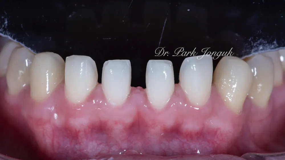 Sinsa Veneers: Beautifully Treating Gapped Teeth and Gum Inflammation With Front Teeth Veneers — photo 9