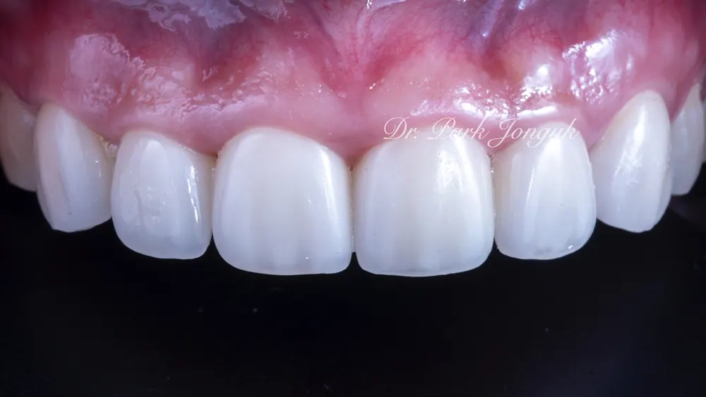 Sinsa Veneers: Beautifully Treating Gapped Teeth and Gum Inflammation With Front Teeth Veneers — photo 10