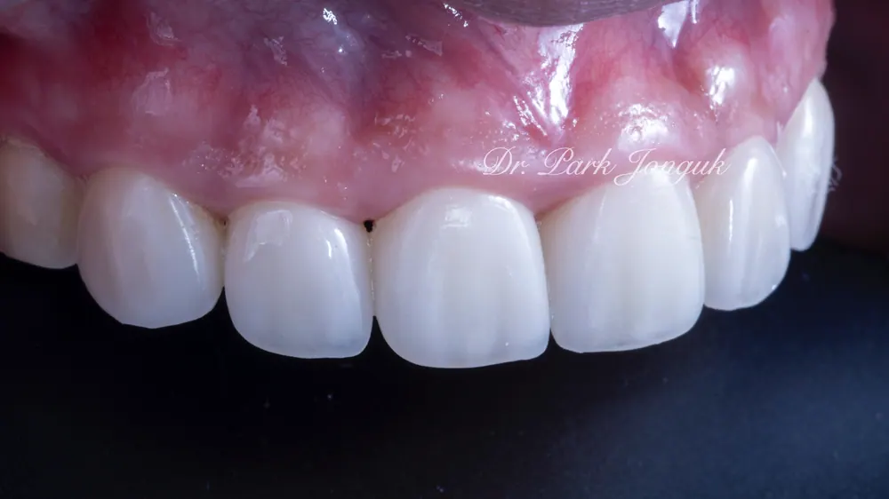 Sinsa Veneers: Beautifully Treating Gapped Teeth and Gum Inflammation With Front Teeth Veneers — photo 11