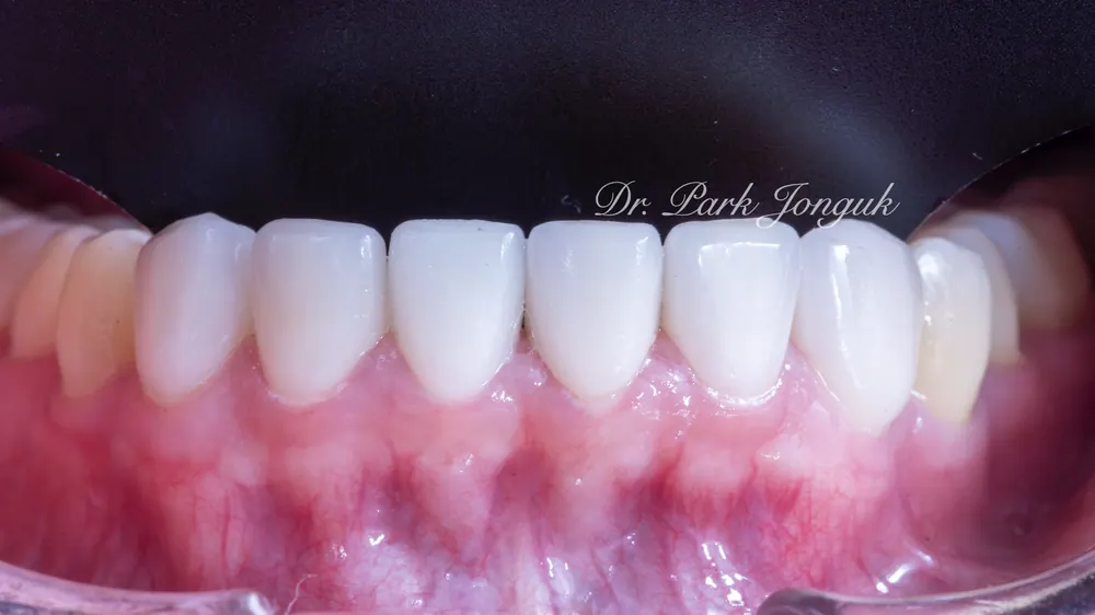 Sinsa Veneers: Beautifully Treating Gapped Teeth and Gum Inflammation With Front Teeth Veneers — photo 13