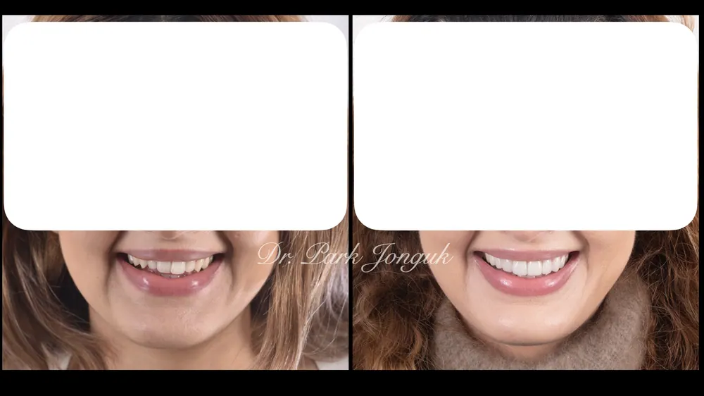 얼굴과 조화를 이루는 앞니 라미네이트 본문 사진 13